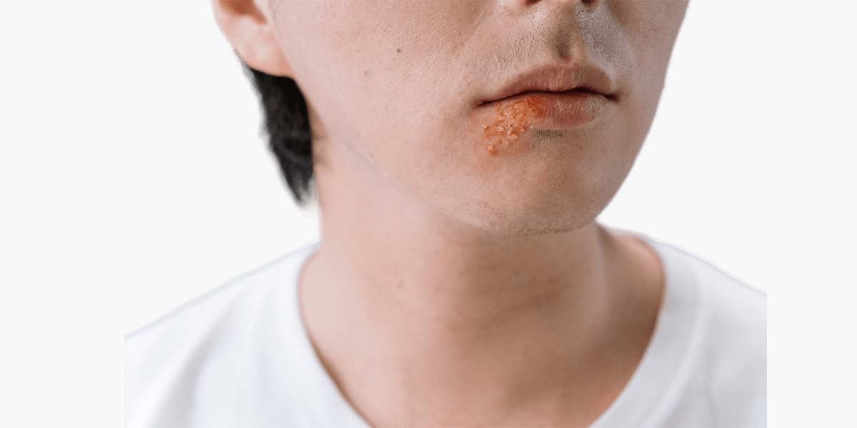 What is Herpes disease? How dangerous is the disease? - Sohimi